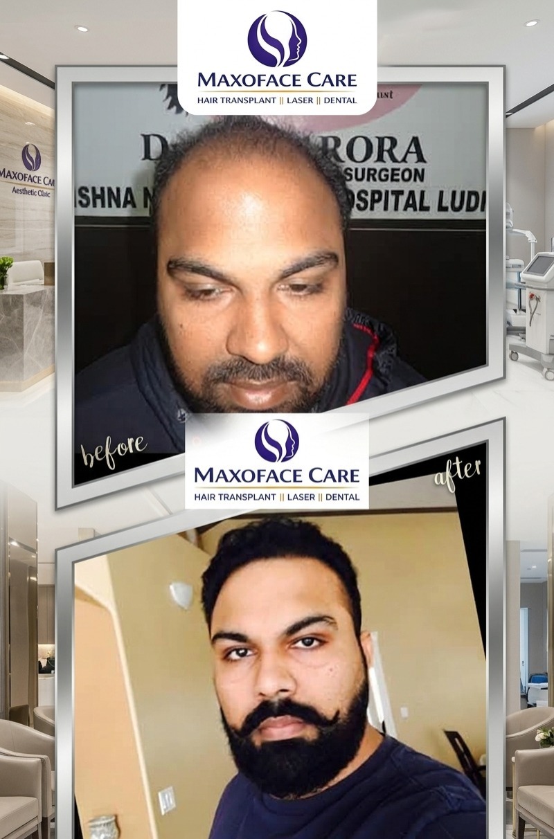 Before & After — Hair Restoration